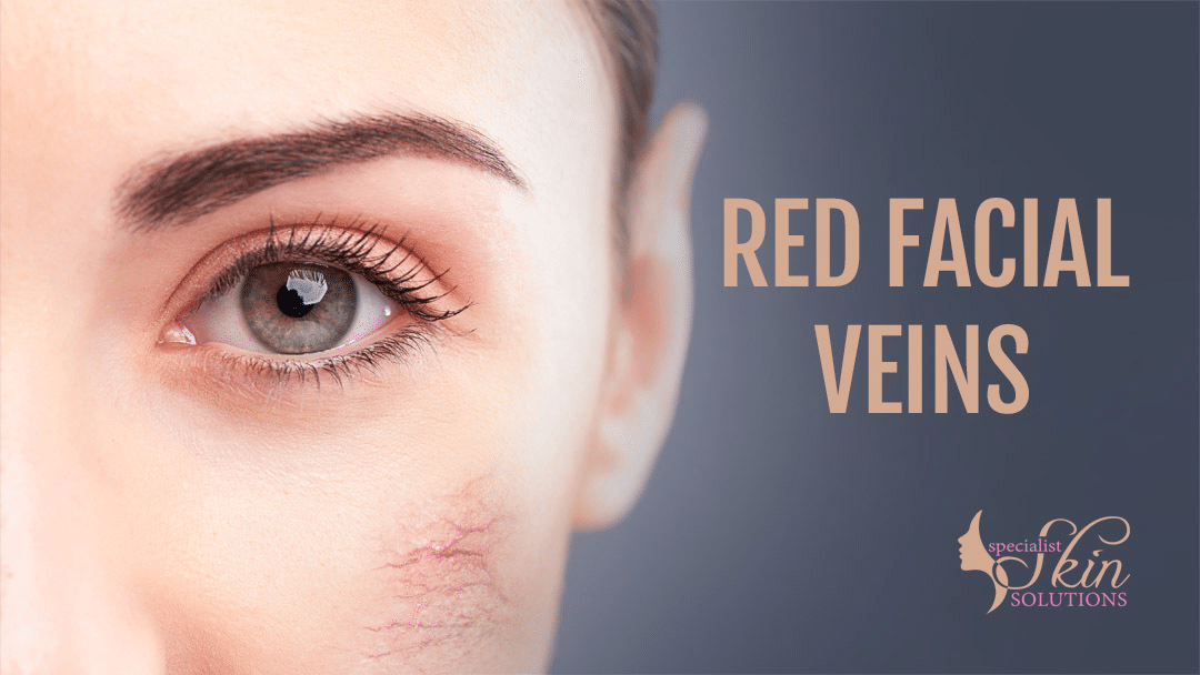 how-to-get-rid-of-spider-veins-on-the-face-with-remedies-treatments