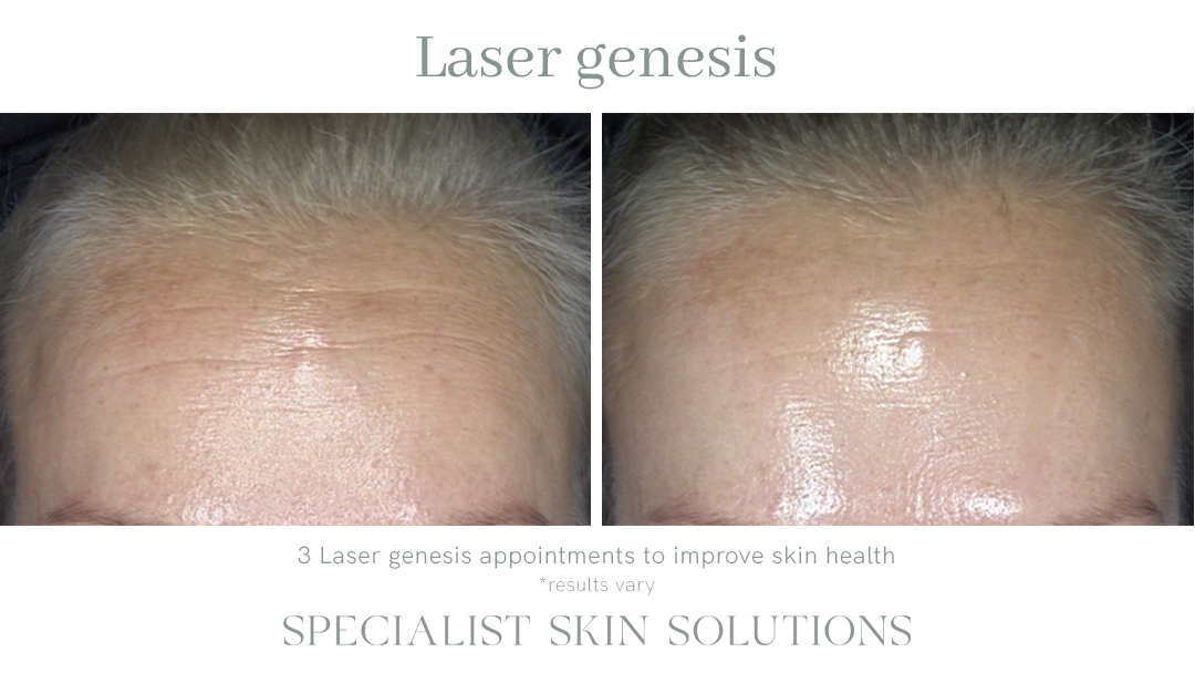 Laser Genesis – SSS Before & After