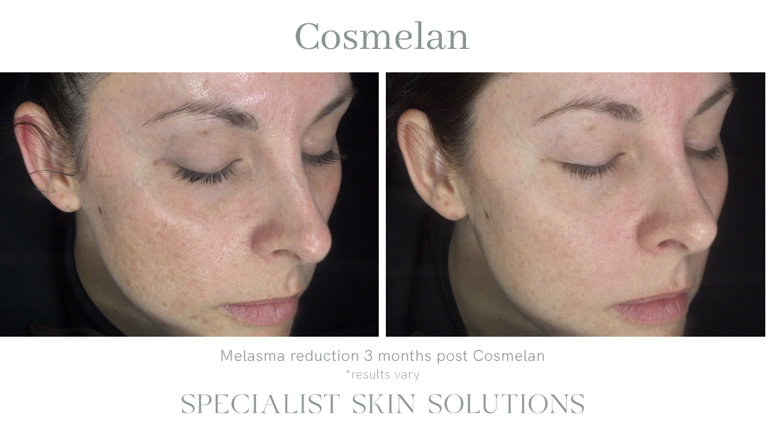 Patient Belinda – Cosmelan – SSS Before & After