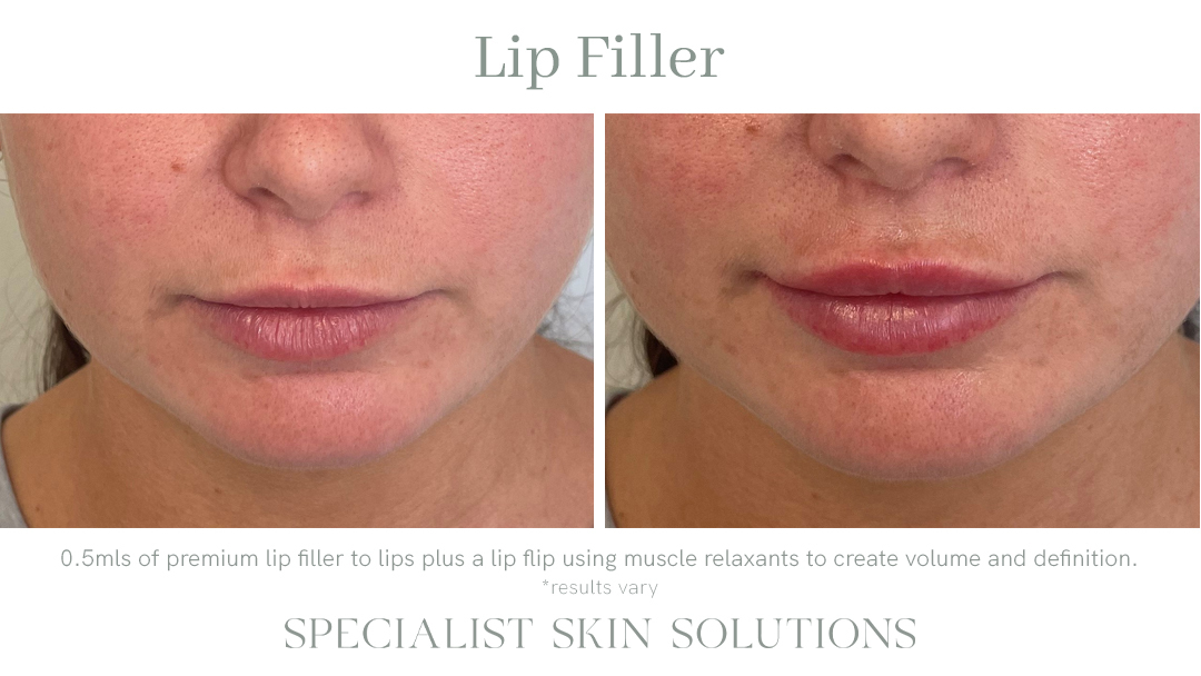 Patient Lucy – Lip Filler – SSS Before & After