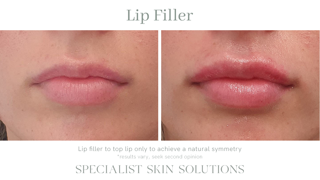Patient Shelby – Lip Filler – SSS Before & After