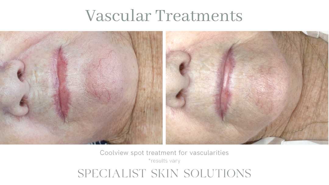 Vascular Treatments – SSS Before & After