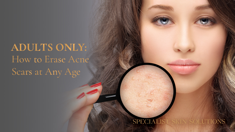 Adults Only - How to Erase Acne Scars at Any Age