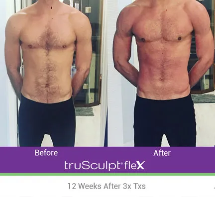 Trusculpt Flex