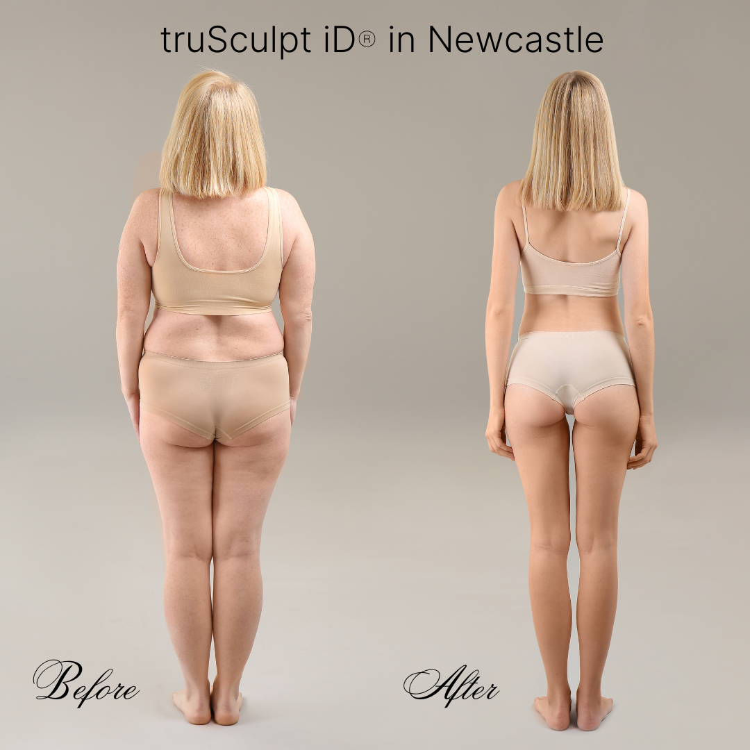 TruSculpt® in Lorn - Hunter Valley